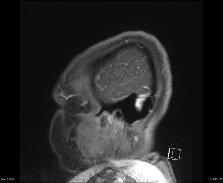 File:Brainstem glioma (Radiopaedia 21819-21775 D 3).jpg