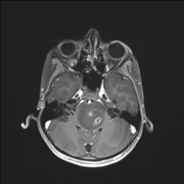 File:Brainstem glioma (Radiopaedia 70548-80674 Axial T1 C+ 44).jpg