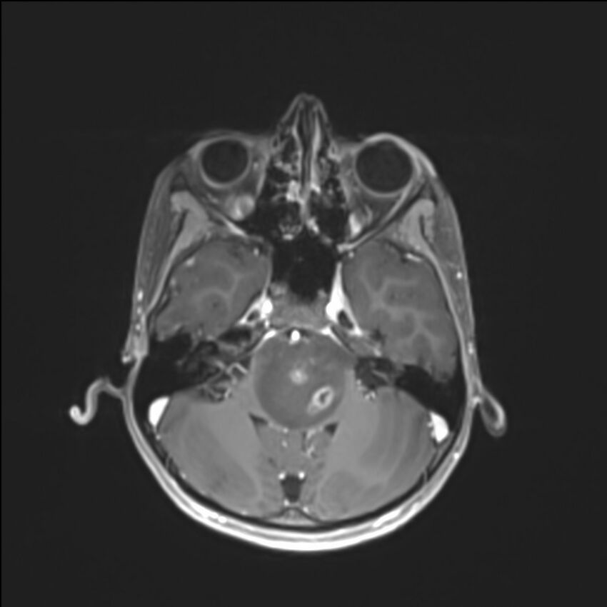 Brainstem glioma (Radiopaedia 70548-80674 Axial T1 C+ 44).jpg
