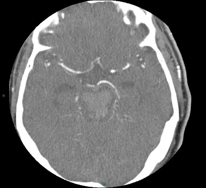 File:Brainstem hemorrhage (Radiopaedia 58794-66028 D 78).jpg