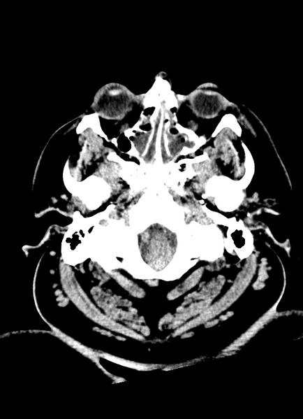 File:Brainstem hemorrhage (Radiopaedia 81294-94976 Axial non-contrast 55).jpg
