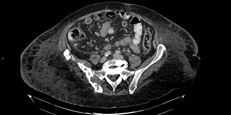File:Breast cancer pelvic bony metastases (Radiopaedia 84470-99824 Axial bone window 24).jpg