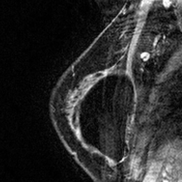 File:Breast implants - MRI (Radiopaedia 26864-27035 Sagittal T2 113).jpg