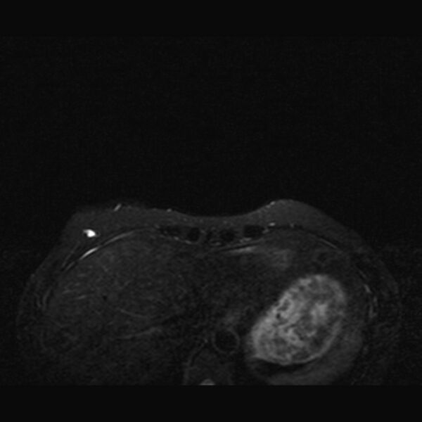File:Breast implants - MRI (Radiopaedia 26864-27035 T2 SPAIR 4).jpg