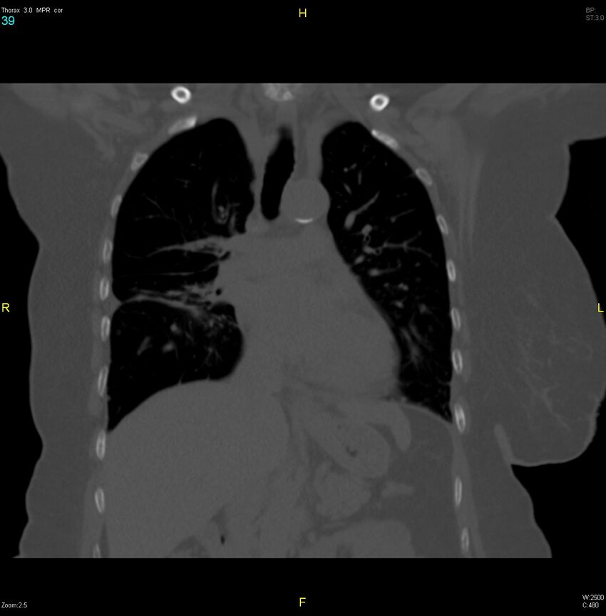 Breast primary with lung and bone metastases (Radiopaedia 40620-43228 bone window 39).jpg