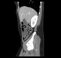 Broad ligament hernia (Radiopaedia 63260-71832 C 14).jpg