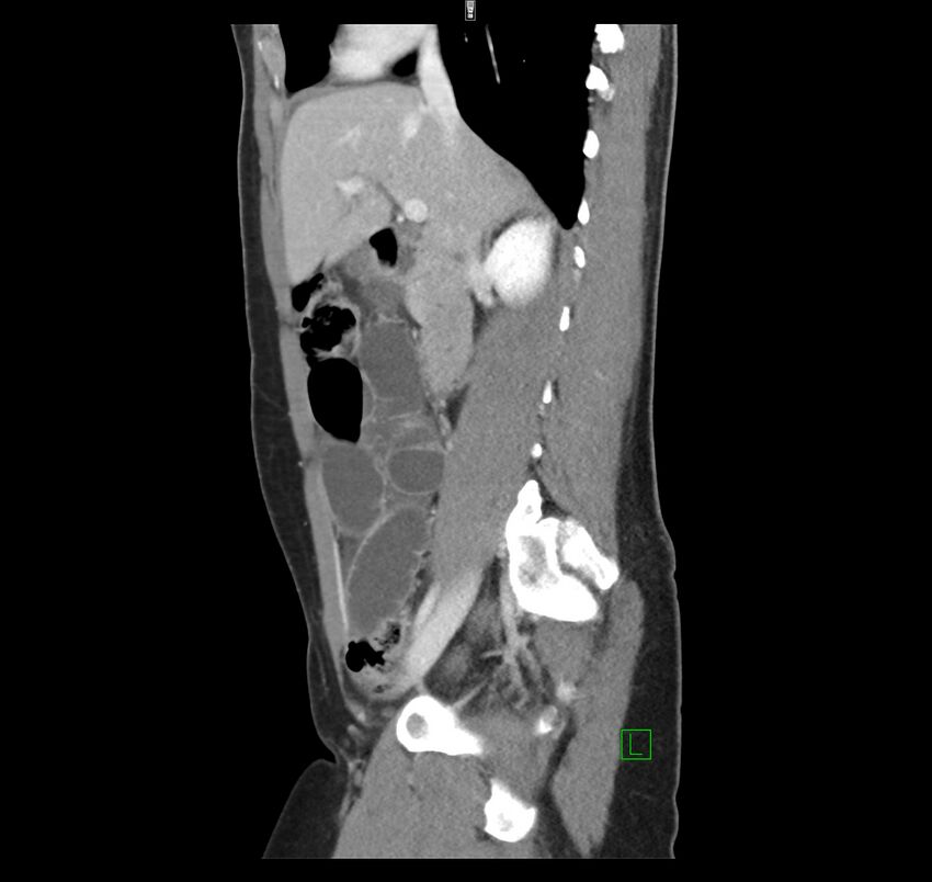 Broad ligament hernia (Radiopaedia 63260-71832 C 20).jpg