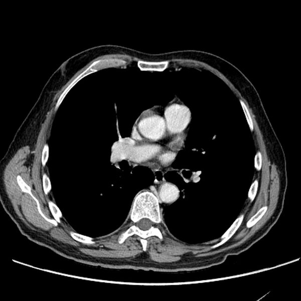 File:Bronchogenic carcinoma with L1 vertebra metastasis (Radiopaedia 9096-9805 Axial C+ delayed 17).jpg
