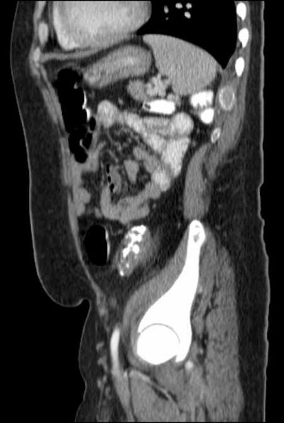 File:Brown tumors compressing the spinal cord (Radiopaedia 68442-77988 F 41).jpg
