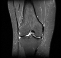 Bucket handle tear - medial meniscus (Radiopaedia 24900-25163 Coronal T2 fat sat 5).png