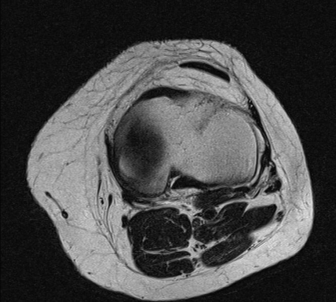 File:Bucket handle tear - medial meniscus (Radiopaedia 79028-91942 Axial T2 8).jpg