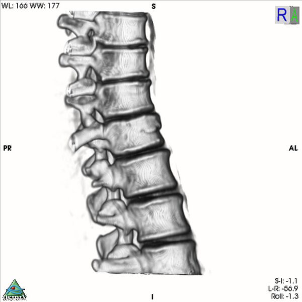 File:Bulging of paraspinal line in traumatic thoracal spinal compression fracture (Radiopaedia 29221-35872 3D VR 3).jpg