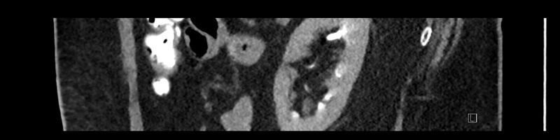 File:Buried bumper syndrome - gastrostomy tube (Radiopaedia 63843-72575 Sagittal Inject 34).jpg