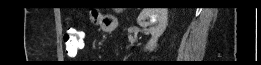 Buried bumper syndrome - gastrostomy tube (Radiopaedia 63843-72575 Sagittal Inject 40).jpg