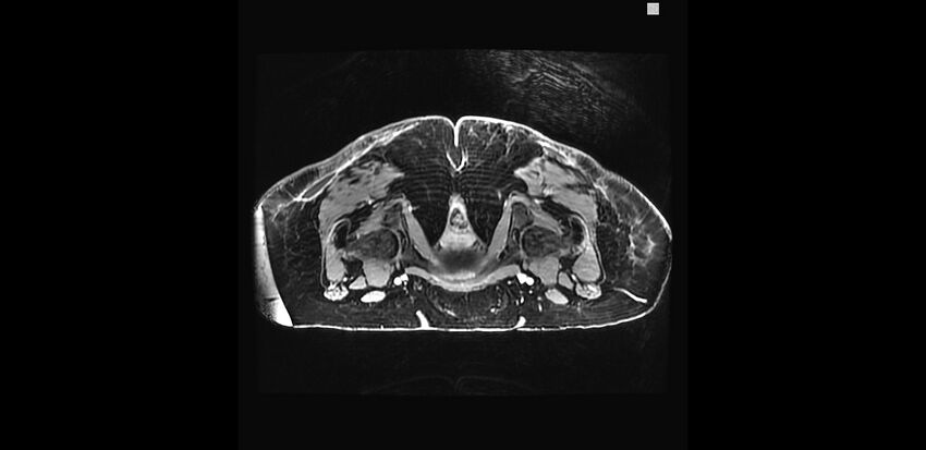 Buttock filler complications (Radiopaedia 63497-72115 Axial T1 C+ 37).jpg