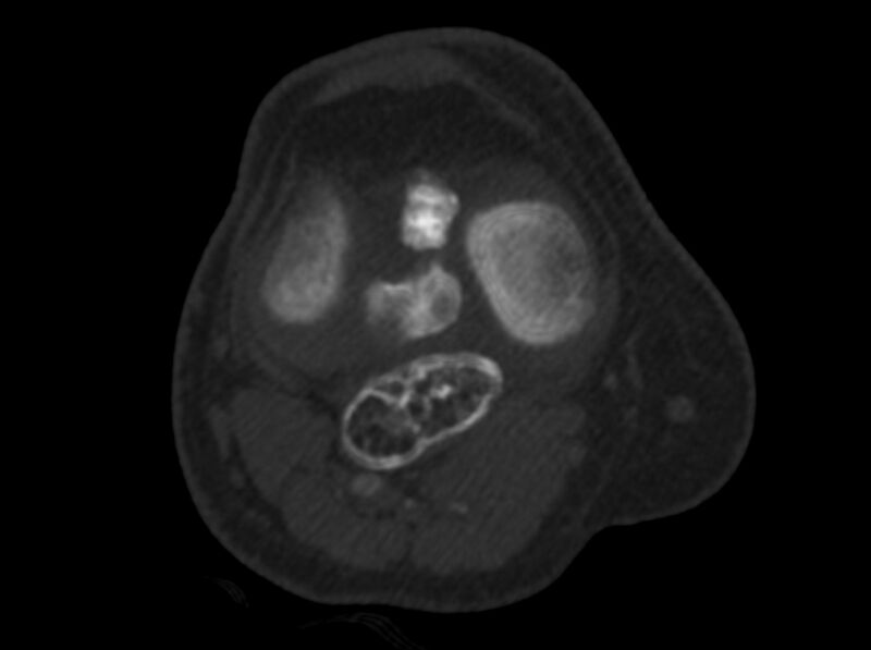 File:Calcified hematoma - popliteal fossa (Radiopaedia 63938-72763 C 21).jpg