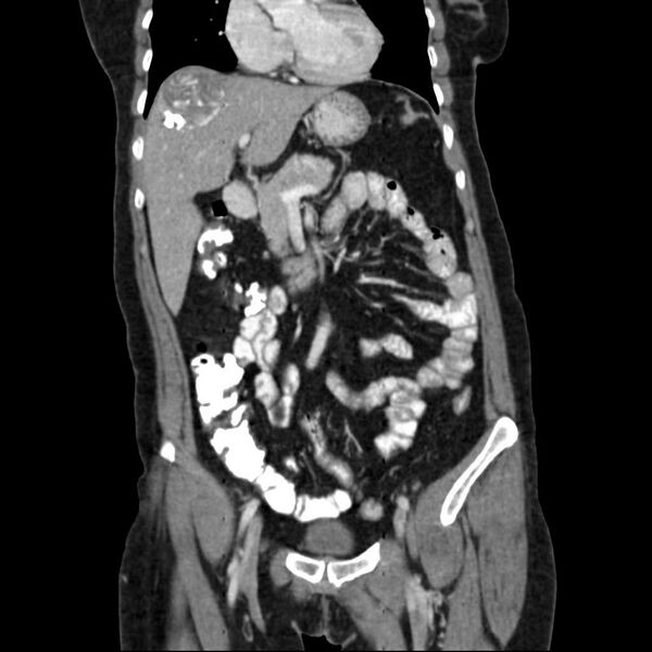 File:Calcified hydatid cyst of the liver (Radiopaedia 21212-21112 D 7).jpg