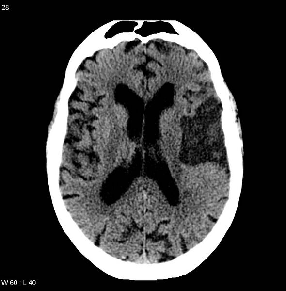 File:Calcified left middle cerebral artery embolism (Radiopaedia 5570-7307 Axial non-contrast 1).jpg
