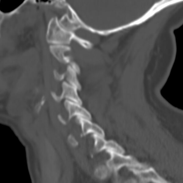 File:Calcified meningioma - cervical canal (Radiopaedia 70136-80171 Sagittal bone window 2).jpg