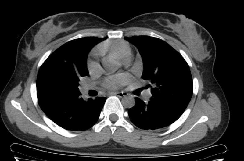 File:Cannonball metastases - uterine choriocarcinoma (Radiopaedia 70137-80173 Axial non-contrast 52).jpg