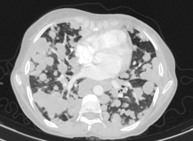 File:Cannonball metastases from breast cancer (Radiopaedia 91024-108569 Axial lung window 59).jpg