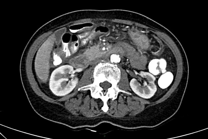 File:Carcinoid mesenteric tumor complicated by chylous ascites (Radiopaedia 76312-88926 A 32).jpg