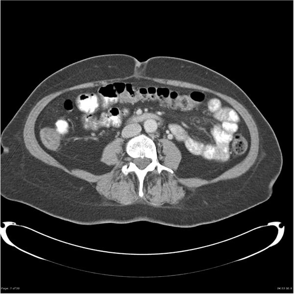 File:Carcinoid tumor of the ileum with metastasis to orbit (Radiopaedia 28165-28425 A 7).jpg