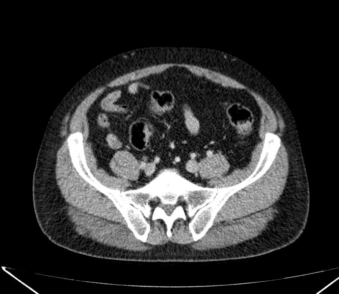File:Carcinoid tumor with hepatic metastases (Radiopaedia 22651-22670 C 64).jpg