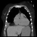 Cardiogenic pulmonary edema (Radiopaedia 29213-29609 Coronal non-contrast 11).jpg