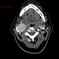 Carotid body tumor (Radiopaedia 20564-20462 C 1).jpg