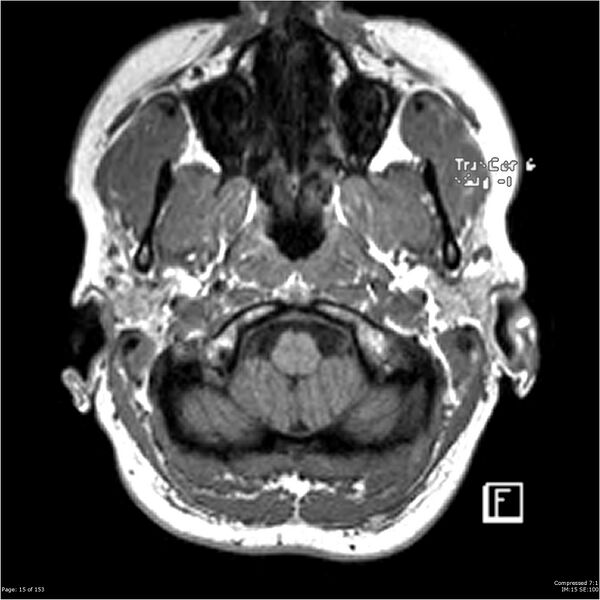 File:Cavernous malformation (cavernous angioma or cavernoma) (Radiopaedia 36675-38237 Axial T1 4).jpg