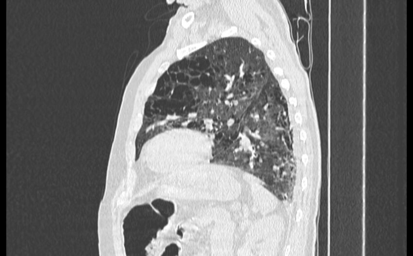Cavitating bronchogenic carcinoma (Radiopaedia 44489-48162 Sagittal lung window 48).jpg