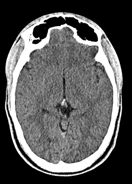 File:Cavum septum pellucidum and cavum vergae (Radiopaedia 77797-90060 Axial Brain Window 48).jpg