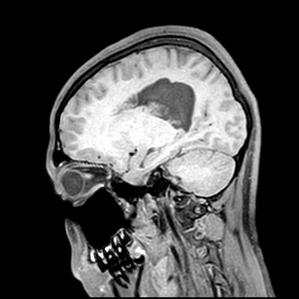File:Central neurocytoma (Radiopaedia 79320-92380 Sagittal T1 171).jpg