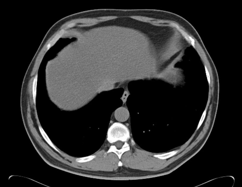 File:Centrilobular pulmonary emphysema (Radiopaedia 26808-26971 Axial non-contrast 36).jpg