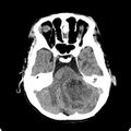Cerebellar abscess secondary to mastoiditis (Radiopaedia 26284-26412 Axial non-contrast 42).jpg