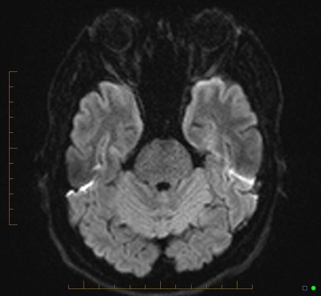 File:Cerebellar gangliocytoma (Radiopaedia 65377-74422 Axial DWI 12).jpg