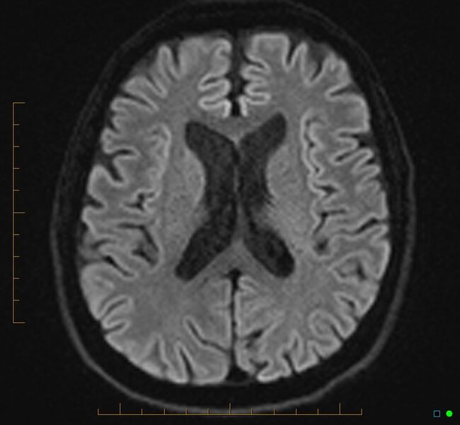 File:Cerebellar gangliocytoma (Radiopaedia 65377-74422 Axial DWI 23).jpg