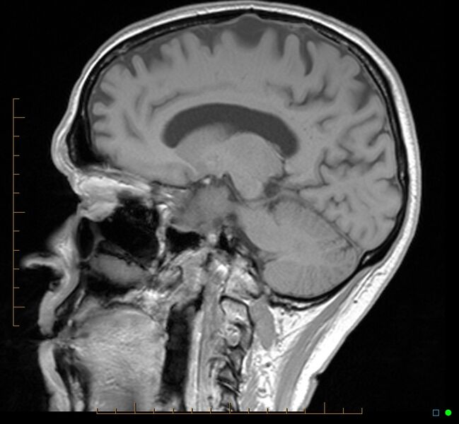 File:Cerebellar gangliocytoma (Radiopaedia 65377-74422 Sagittal T1 26).jpg