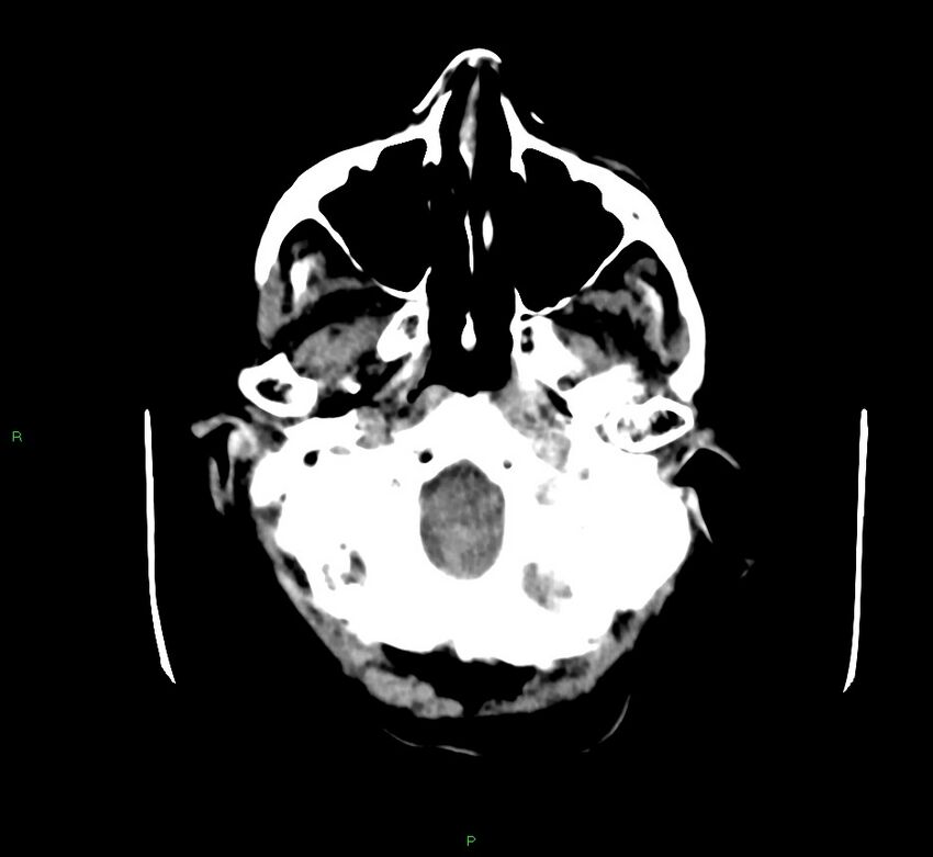 Cerebellar hemorrhage (Radiopaedia 58792-66026 Axial non-contrast 45).jpg