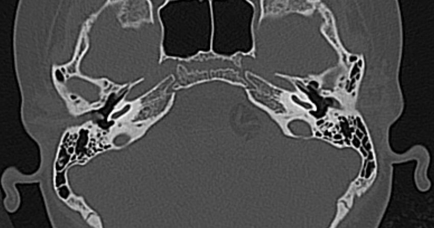 Cerebellopontine angle lipoma (Radiopaedia 57303-64242 Axial bone window 22).jpg