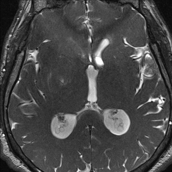 File:Cerebellopontine angle meningioma (Radiopaedia 24459-24764 I 56).jpg