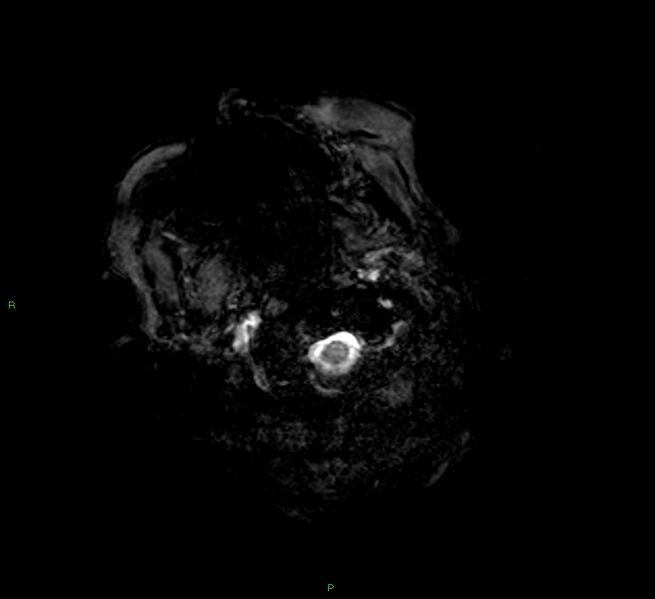 File:Cerebral amyloid angiopathy-associated lobar intracerebral hemorrhage (Radiopaedia 58377-65515 Axial Gradient Echo 24).jpg