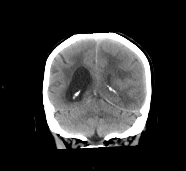 File:Cerebral amyloid angiopathy-associated lobar intracerebral hemorrhage (Radiopaedia 58561-65724 Coronal non-contrast 22).jpg