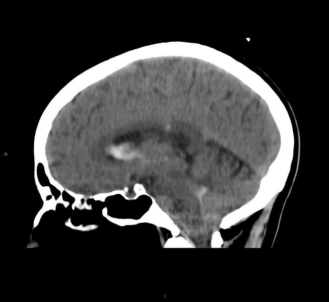 File:Cerebral amyloid angiopathy-associated lobar intracerebral hemorrhage (Radiopaedia 58566-65730 C 27).jpg
