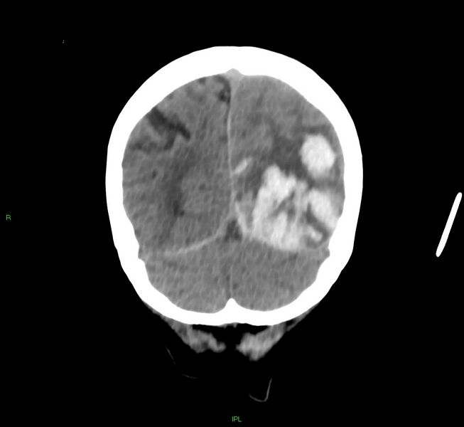 File:Cerebral amyloid angiopathy-associated lobar intracerebral hemorrhage (Radiopaedia 58754-65975 Coronal non-contrast 16).jpg