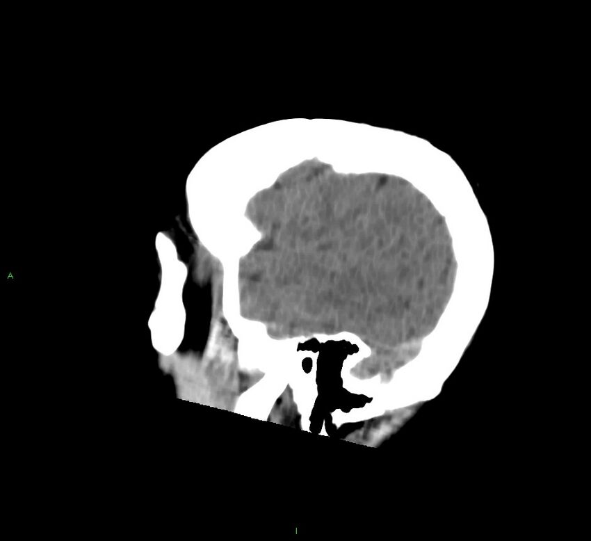 Cerebral amyloid angiopathy-associated lobar intracerebral hemorrhage (Radiopaedia 58756-65977 C 48).jpg