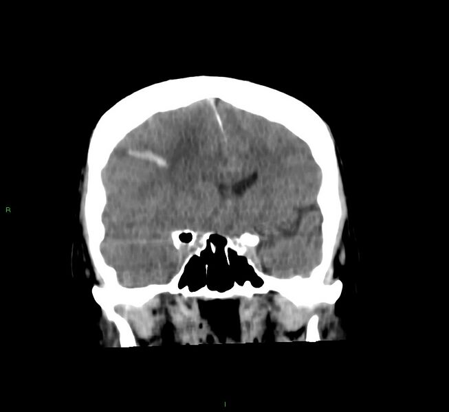 File:Cerebral amyloid angiopathy-associated lobar intracerebral hemorrhage (Radiopaedia 58756-65977 Coronal non-contrast 42).jpg