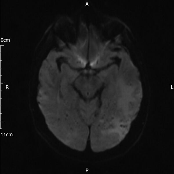 File:Cerebral amyloid angiopathy related inflammation (Radiopaedia 72772-83415 Axial DWI 33).jpg