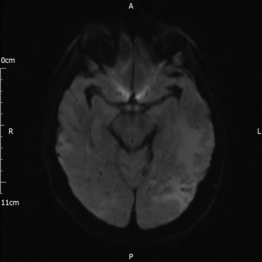 Cerebral amyloid angiopathy related inflammation (Radiopaedia 72772-83415 Axial DWI 33).jpg